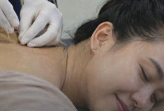 Dry Needling 