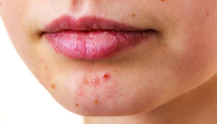 Mengapa Soal Jerawat Butuh Perhatian? Ini Penjelasannya
