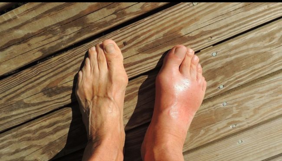 Asam Urat Bisa Sembuh dengan Rutin Kompres Kaki Pakai Batu Es, Emangnya Manjur?