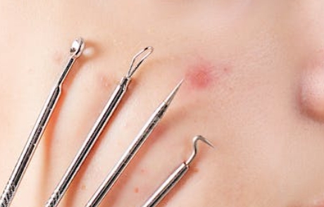 4 Jenis Makanan yang Harus Dihindari untuk Mencegah Munculnya Jerawat