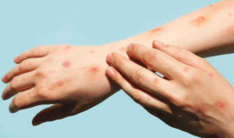 Jumlah Penderita Mencapai 44 Pasien, DKI Kebut Pemberian Vaksinasi Cacar Monyet