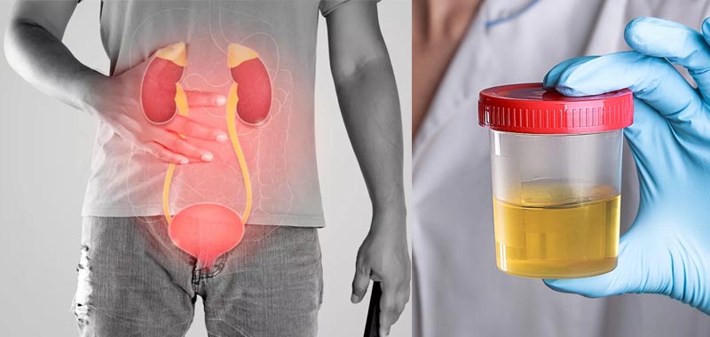 Ketaui Penyebab Urine Kencing Kita Berubah Warna Berikut Penjelasannya