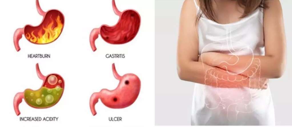Tips Minum Obat Asam Lambung Selama Puasa
