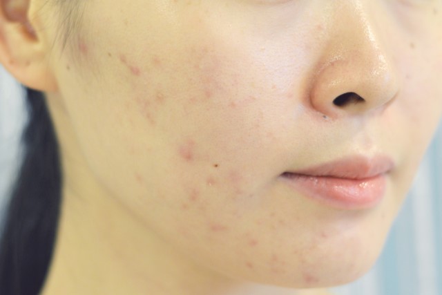 Rekomendasi Masker Alami untuk Menghilangkan Bruntusan di Wajah