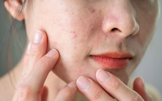 Cara Ini Efektif Hilangkan Bopeng Bekas Jerawat di Wajah .