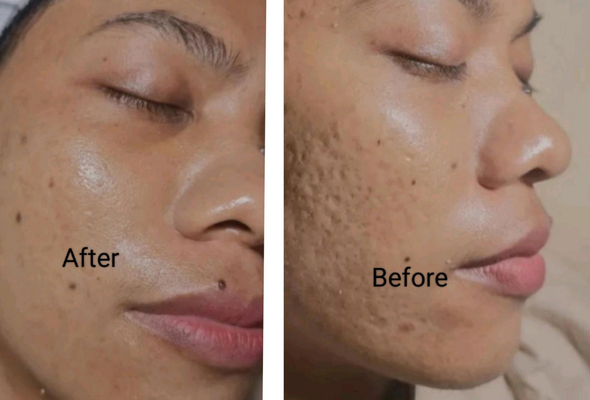 Hilangkan Bekas Luka Scar dengan Metode Skin Boost Rejuvenating 